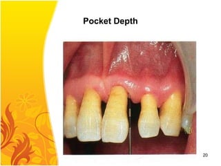 Pocket Depth
20
 