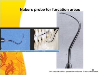 Nabers probe for furcation areas
21
 