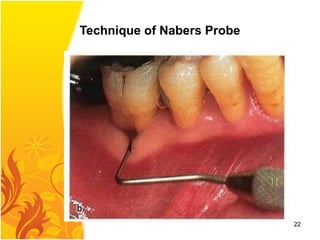Technique of Nabers Probe
22
 