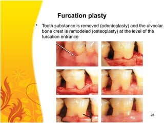 Furcation plasty
• Tooth substance is removed (odontoplasty) and the alveolar
bone crest is remodeled (osteoplasty) at the level of the
furcation entrance
28
 