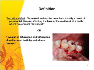 Definition
“Furcation defect : Term used to describe bone loss, usually a result of
periodontal disease, affecting the base of the root trunk of a tooth
where two or more roots meet.”
OR
“Invasion of bifurcation and trifurcation
of multi-rooted teeth by periodontal
Disease”
7
 