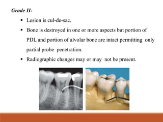 Grade II-
 Lesion is cul-de-sac.
 Bone is destroyed in one or more aspects but portion of
PDL and portion of alvolar bone are intact permitting only
partial probe penetration.
 Radiographic changes may or may not be present.
 