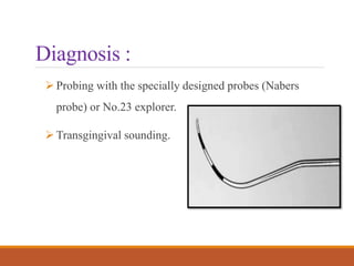Diagnosis :
Probing with the specially designed probes (Nabers
probe) or No.23 explorer.
Transgingival sounding.
 