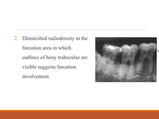 2. Diminished radiodensity in the
furcation area in which
outlines of bony trabeculae are
visible suggests furcation
involvement.
 