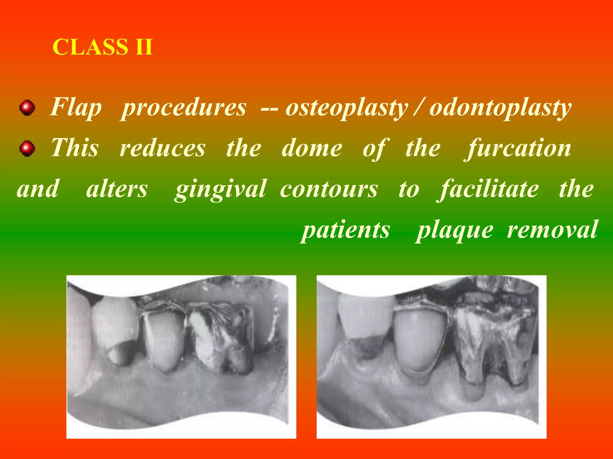 CLASS II
Flap procedures -- osteoplasty / odontoplasty
This reduces the dome of the furcation
and alters gingival contours to facilitate the
patients plaque removal
 