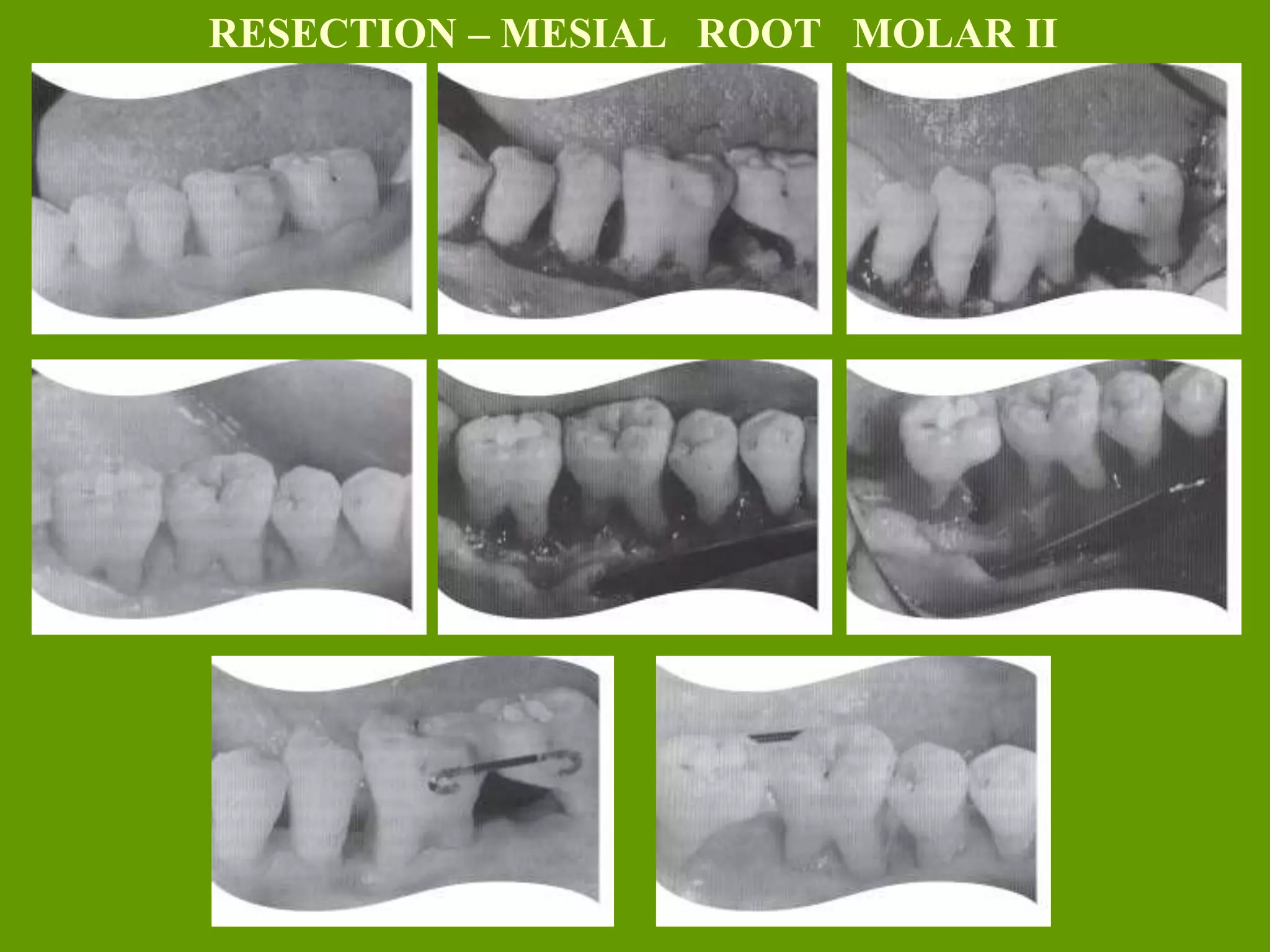 RESECTION – MESIAL ROOT MOLAR II
 