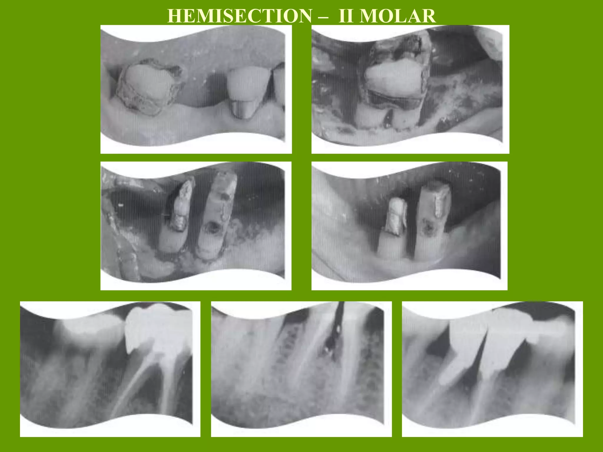 HEMISECTION – II MOLAR
 