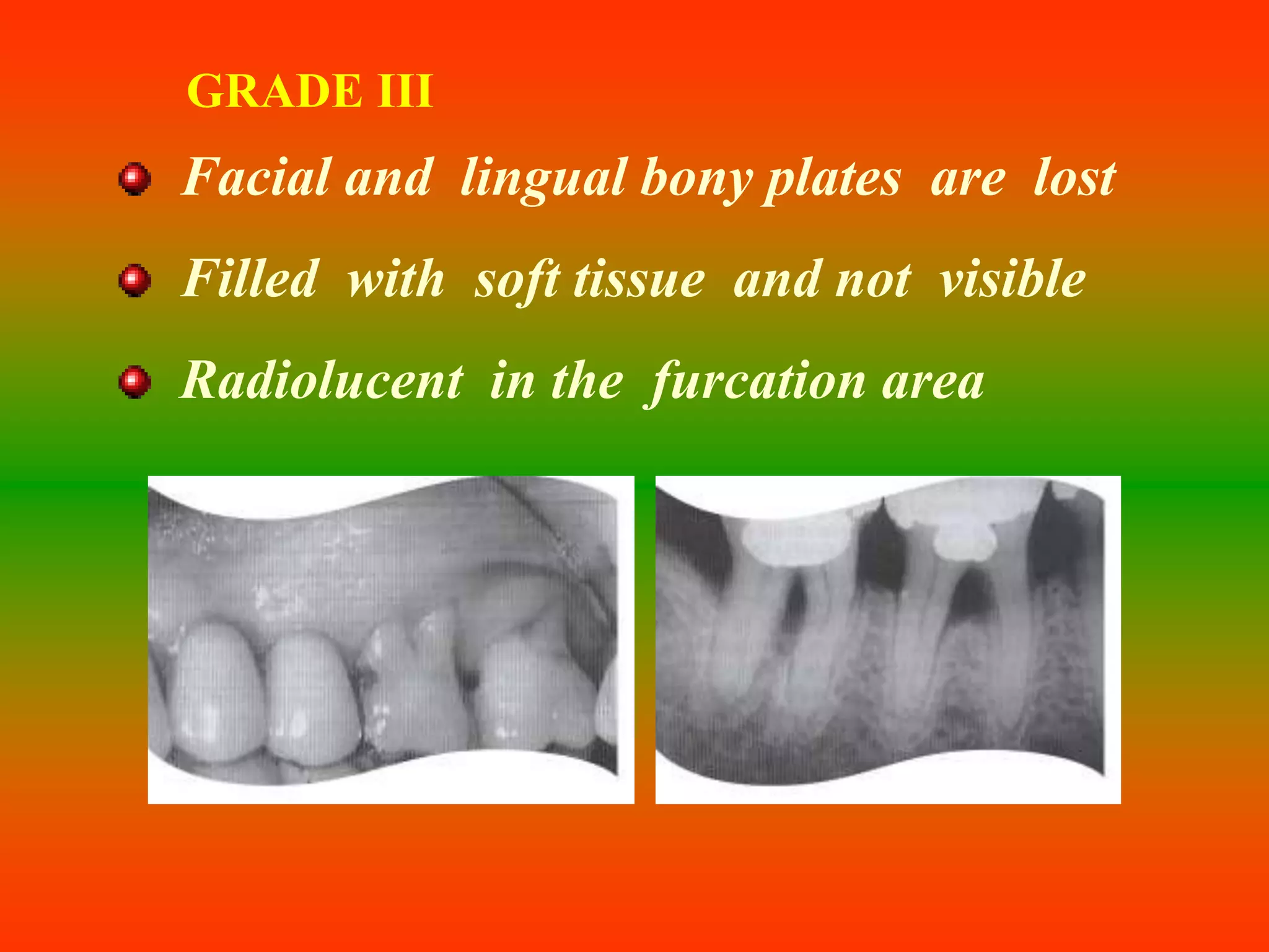 GRADE III
Facial and lingual bony plates are lost
Filled with soft tissue and not visible
Radiolucent in the furcation area
 