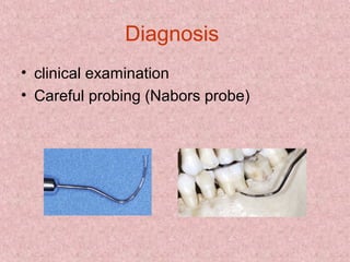 Diagnosis
• clinical examination
• Careful probing (Nabors probe)
 