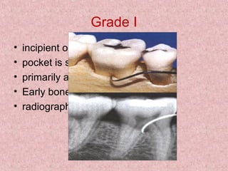 Grade I
• incipient or early stage
• pocket is suprabony
• primarily affects the soft tissues
• Early bone loss
• radiographic changes
 