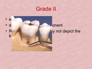 Grade II
• essentially a cul-de-sac
• definite horizontal component
• Radiographs may or may not depict the
furcation involvement
 