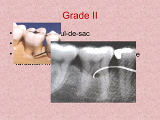 Grade II
• essentially a cul-de-sac
• definite horizontal component
• Radiographs may or may not depict the
furcation involvement
 