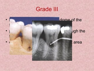 Grade III
• bone is not attached to the dome of the
furcation
• periodontal probe completely through the
furcation
• display the defect as a radiolucent area
 