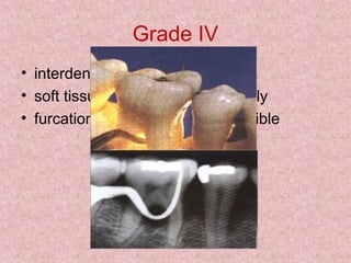 Grade IV
• interdental bone is destroyed
• soft tissues have receded apically
• furcation opening is clinically visible
 