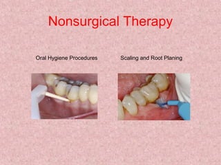 Nonsurgical Therapy
Oral Hygiene Procedures Scaling and Root Planing
 