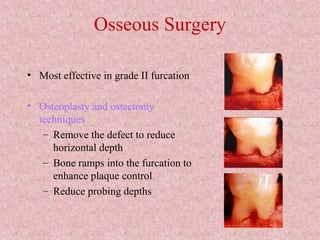 Osseous Surgery
• Most effective in grade II furcation
• Osteoplasty and ostectomy
techniques
– Remove the defect to reduce
horizontal depth
– Bone ramps into the furcation to
enhance plaque control
– Reduce probing depths
 