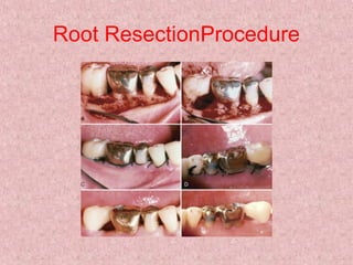 Root ResectionProcedure
 