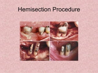Hemisection Procedure
 