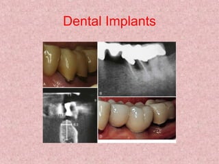 Dental Implants
 