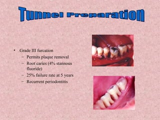 • Grade III furcation
– Permits plaque removal
– Root caries (4% stannous
fluoride)
– 25% failure rate at 5 years
– Recurrent periodontitis
 
