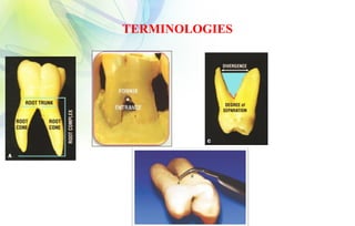 FURCATION And Its Management In Periodontics | PPTX