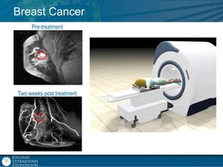 Breast Cancer
Pre-treatment

Two weeks post treatment

 