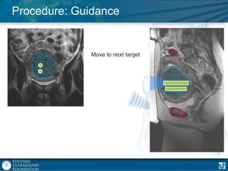 Procedure: Guidance

Move to next target

 
