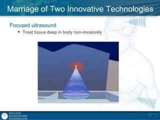 Marriage of Two Innovative Technologies
Focused ultrasound
 Treat tissue deep in body non-invasively

 
