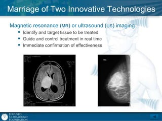 Marriage of Two Innovative Technologies
Magnetic resonance (MR) or ultrasound (US) imaging
 Identify and target tissue to be treated
 Guide and control treatment in real time
 Immediate confirmation of effectiveness

 