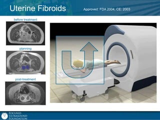 Uterine Fibroids
before treatment

planning

post-treatment

Approved: FDA 2004, CE: 2003

 