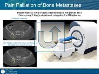 Pain Palliation of Bone Metastases
Patient with osteolytic breast cancer metastasis at right iliac bone
Pain score of 5.5 before treatment reduced to 0 at 3M follow up
CT Before Treatment

Note: At 3M new bone formation and thickening
of cortical layer in treatment area

 