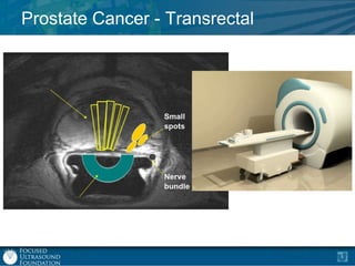 Prostate Cancer - Transrectal

 