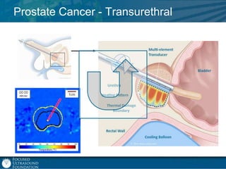 Prostate Cancer - Transurethral

 