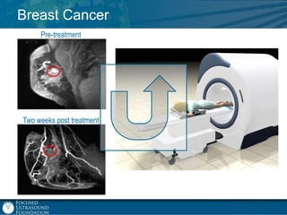 Breast Cancer
Pre-treatment

Two weeks post treatment

 