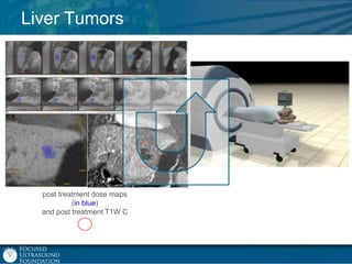 Liver Tumors

post treatment dose maps
(in blue)
and post treatment T1W C

 