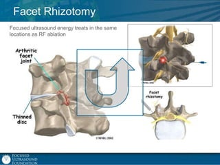 Facet Rhizotomy
Focused ultrasound energy treats in the same
locations as RF ablation

 