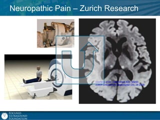 Neuropathic Pain – Zurich Research

 