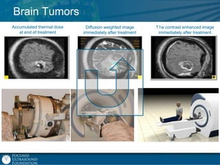 Brain Tumors
Accumulated thermal dose
at end of treatment

Diffusion weighted image
immediately after treatment

T1w contrast enhanced image
immediately after treatment

 