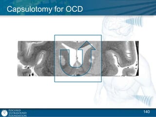 Capsulotomy for OCD

140

 
