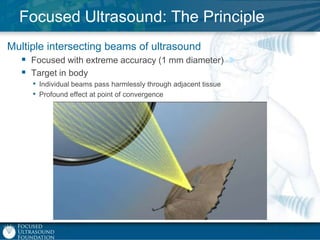 Focused Ultrasound: The Principle
Multiple intersecting beams of ultrasound
 Focused with extreme accuracy (1 mm diameter)
 Target in body
• Individual beams pass harmlessly through adjacent tissue
• Profound effect at point of convergence

 