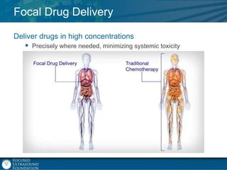 Focal Drug Delivery
Deliver drugs in high concentrations
 Precisely where needed, minimizing systemic toxicity

 