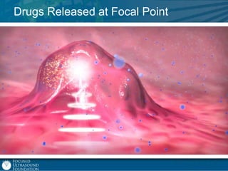 Drugs Released at Focal Point

 