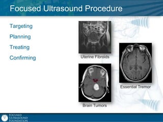Focused Ultrasound Procedure
Targeting
Planning
Treating

Confirming

Uterine Fibroids

Essential Tremor

Brain Tumors

 