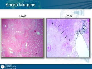 Sharp Margins
Liver

Treated

1 mm

Brain

 
