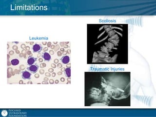 Limitations
Scoliosis

Leukemia

Traumatic Injuries

 