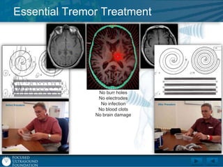 Essential Tremor Treatment

Awake, no anesthesia
No incisions
No burr holes
No electrodes
No infection
No blood clots
No brain damage

 