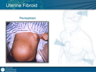 Uterine Fibroid
Pre-treatment

 