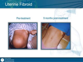Uterine Fibroid
Pre-treatment

9 months post-treatment

 