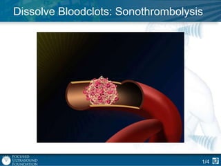 Dissolve Bloodclots: Sonothrombolysis

1/4

 
