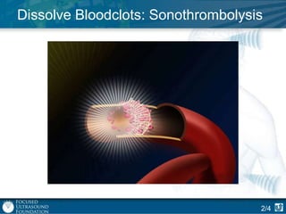 Dissolve Bloodclots: Sonothrombolysis

2/4

 